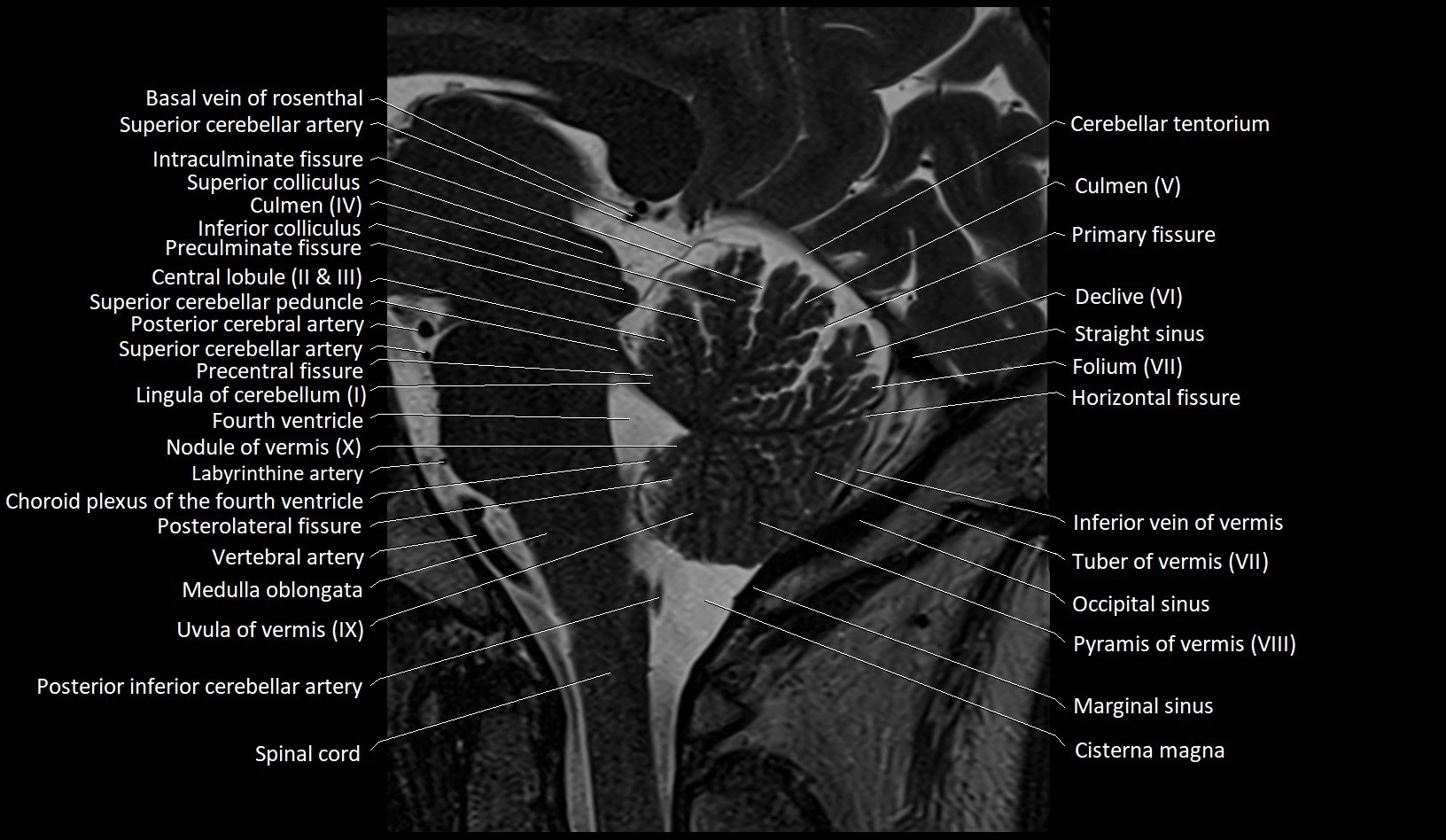 MRI Cerebellar anatomy sagittal High-resolution labelled image 28.webp